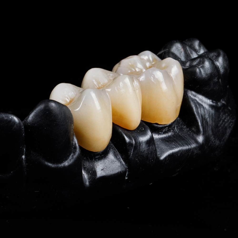 golden-dental-lab_services_crown-and-bridge