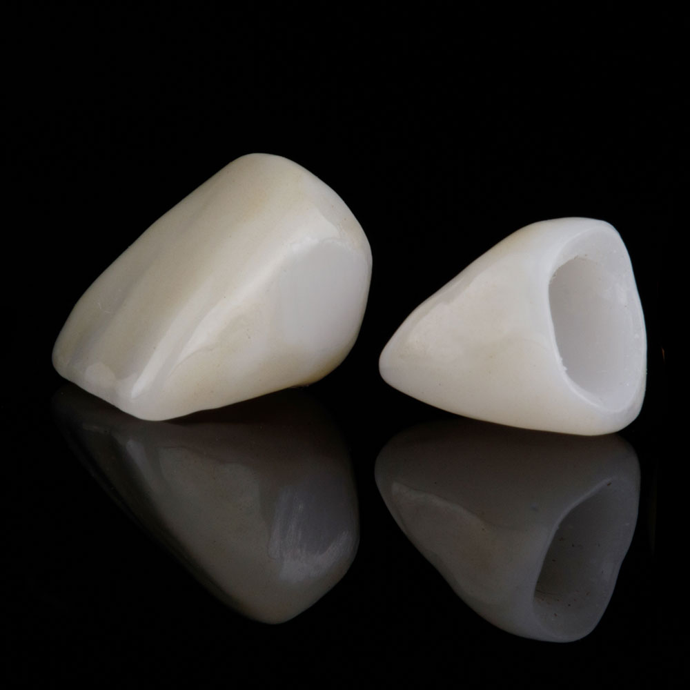 golden-dental-lab_services_veneers